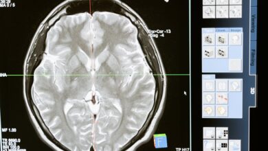Photo of Sassari l’Open day per l’epilessia